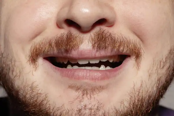 Who is a Good Candidate for Dental Veneers (Hollywood Smile)?